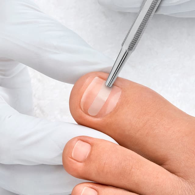 Toenail Correction Plan (3 Visits) at Hey Girl Hey Nail Salon in Searcy, AR